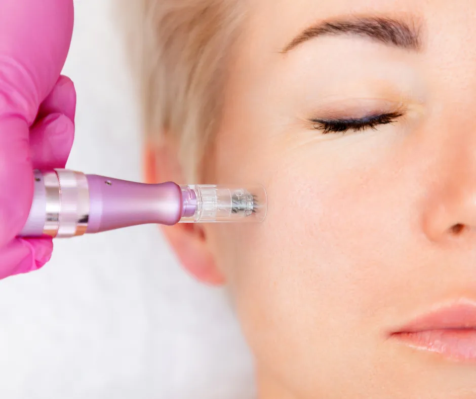 Microneedling Facial Treatment
