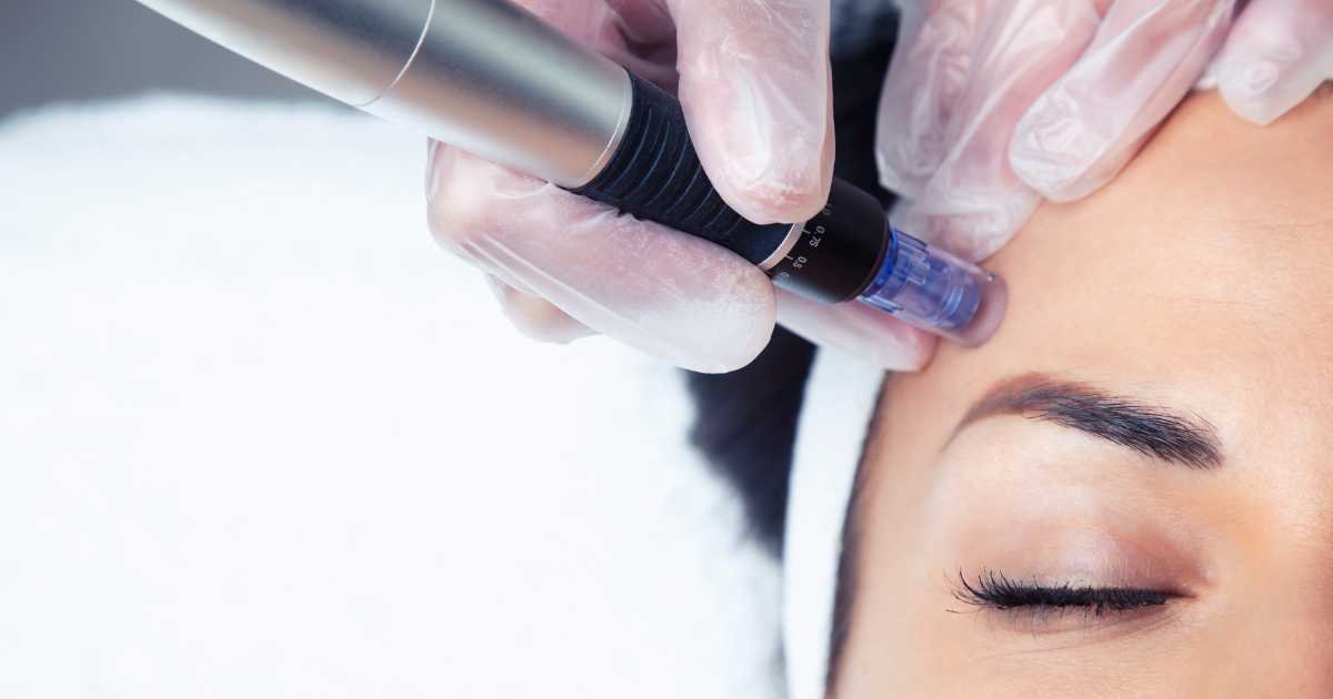 Microneedling facial treatment at Iconic Brow Wax N Beauty North Lakes